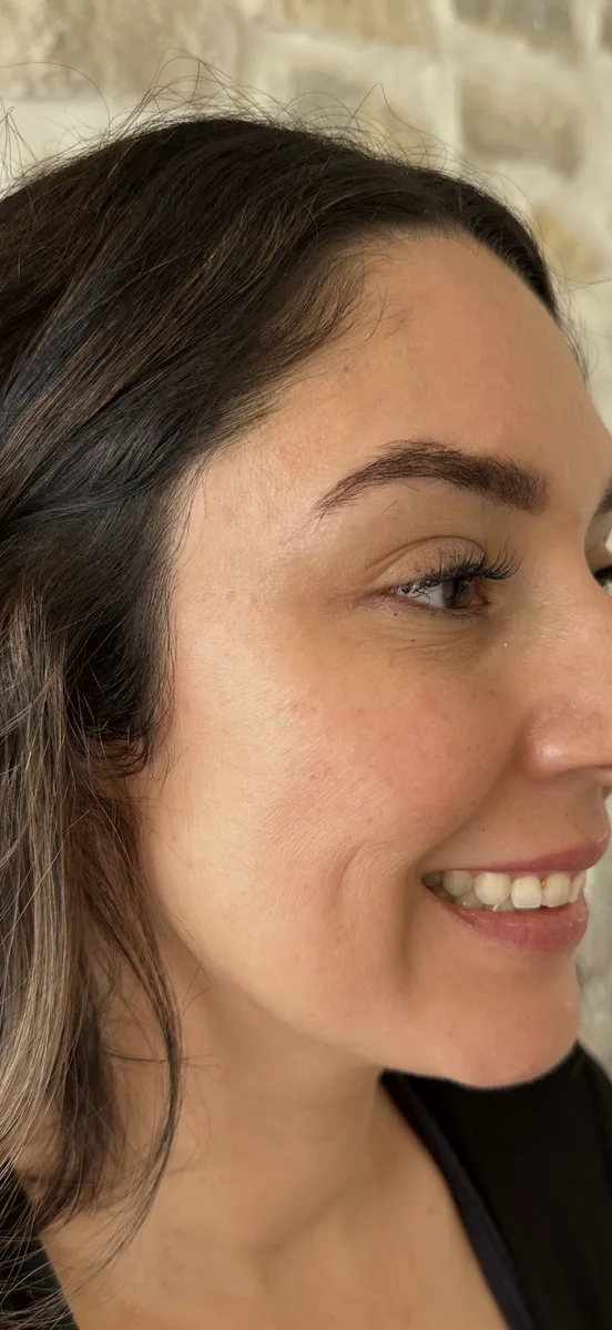 Botox — Forehead & Crow's Feet — after