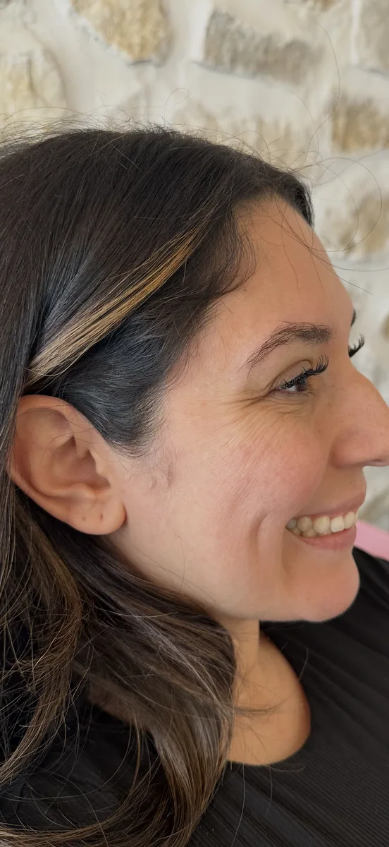 Botox — Forehead & Crow's Feet — before